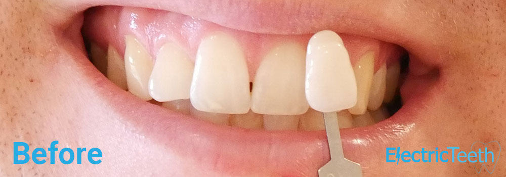 How can you get white spots off your teeth