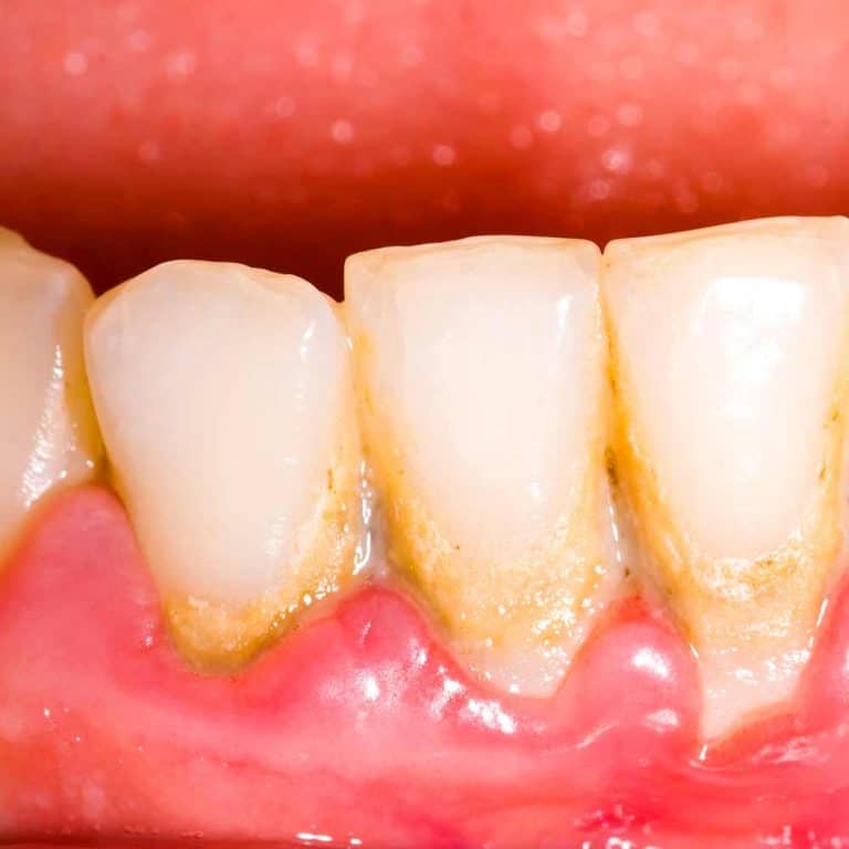 Tooth Decay: Signs, Symptoms & Treatments - Electric Teeth