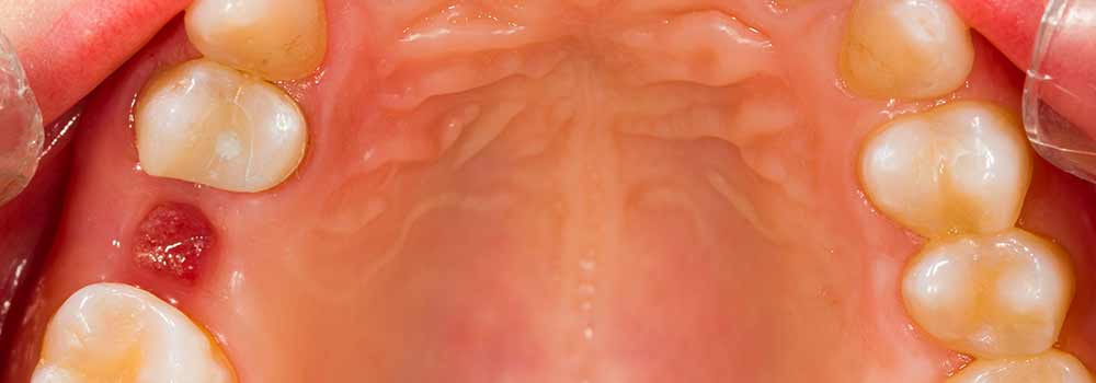wisdom tooth remol normal healing images