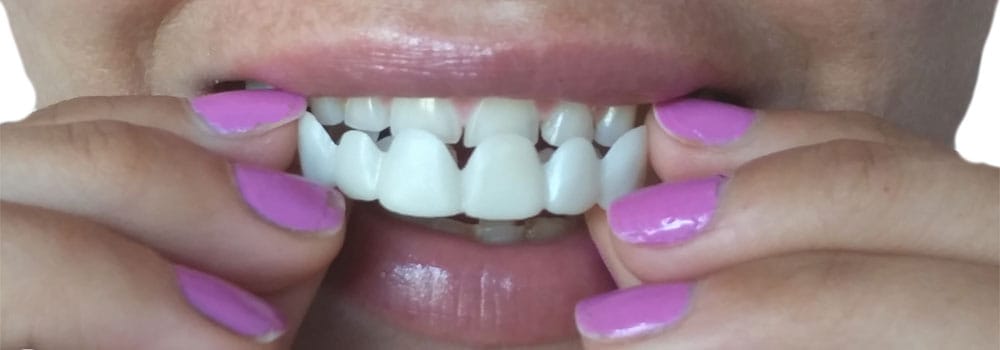 Best Snap On Veneers The Internet Isn T The Place To Find Them