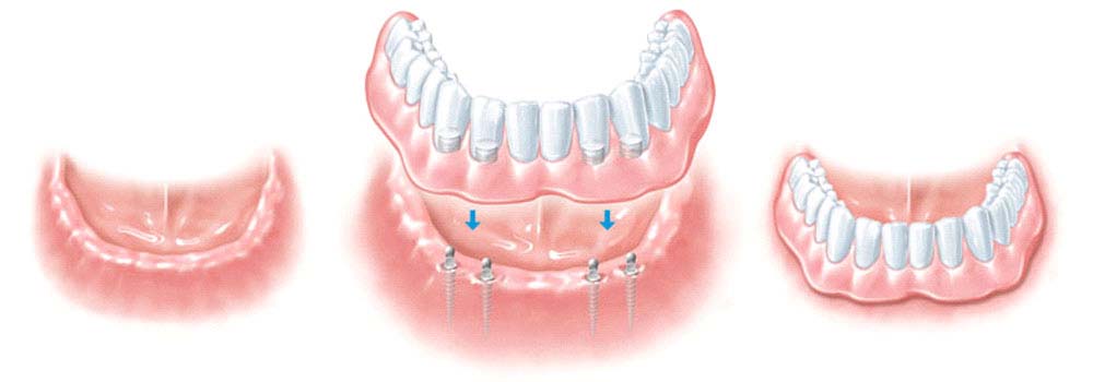 Mini impianti dentali Midi: Costi, Procedura FAQ 3