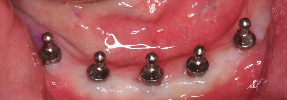 Mini-Midi-Dentalimplantate: Kosten, Ablauf FAQ 4