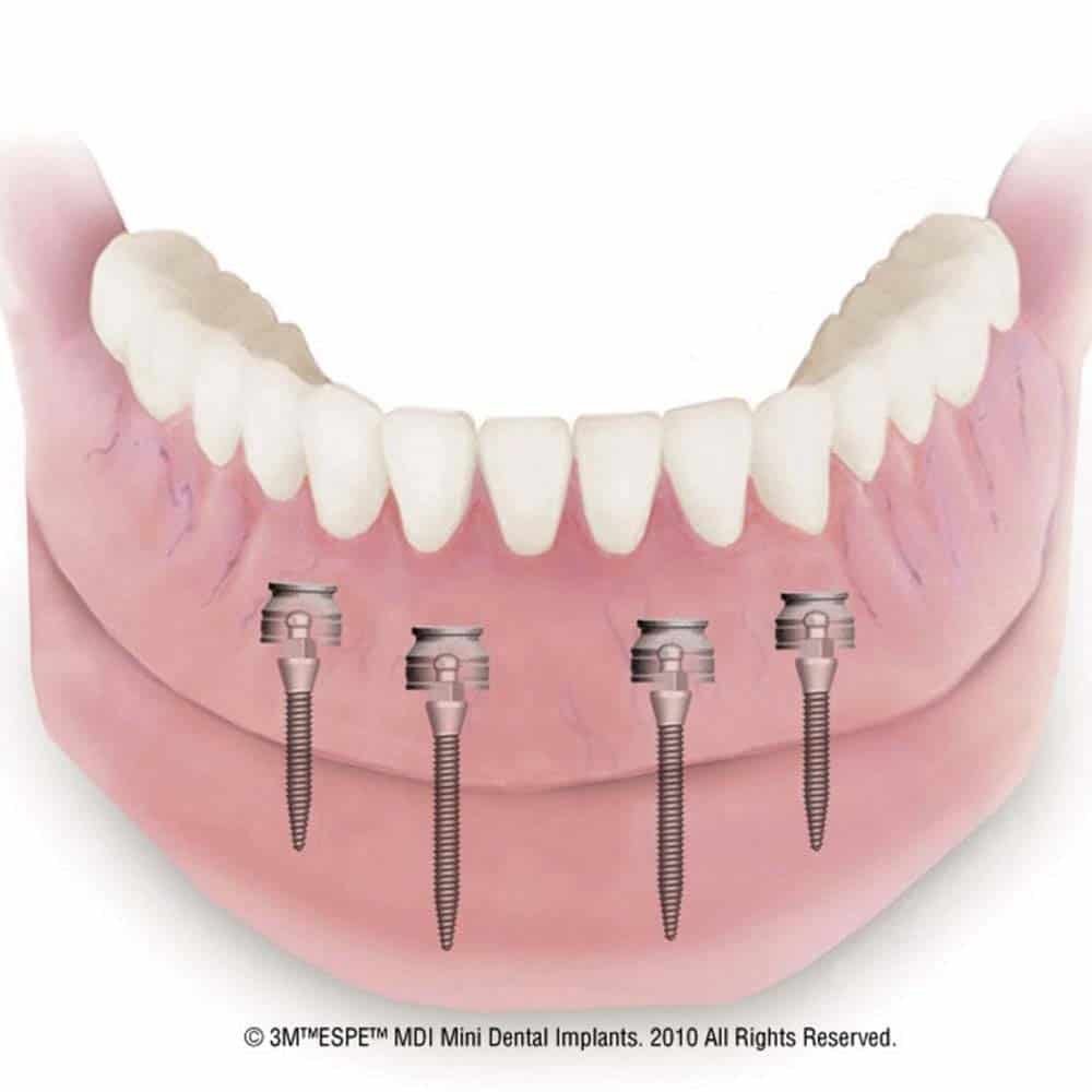 Mini Midi Implantes Dentários: Custos, Procedimento FAQ 8