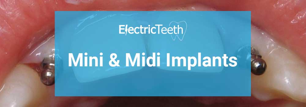 Implants mini et midi - Image d'en-tête