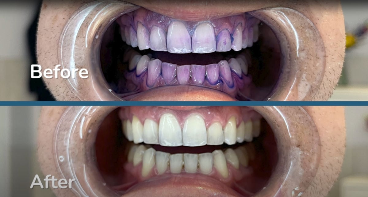 Oral-B iO2 plaque disclosing test before and after